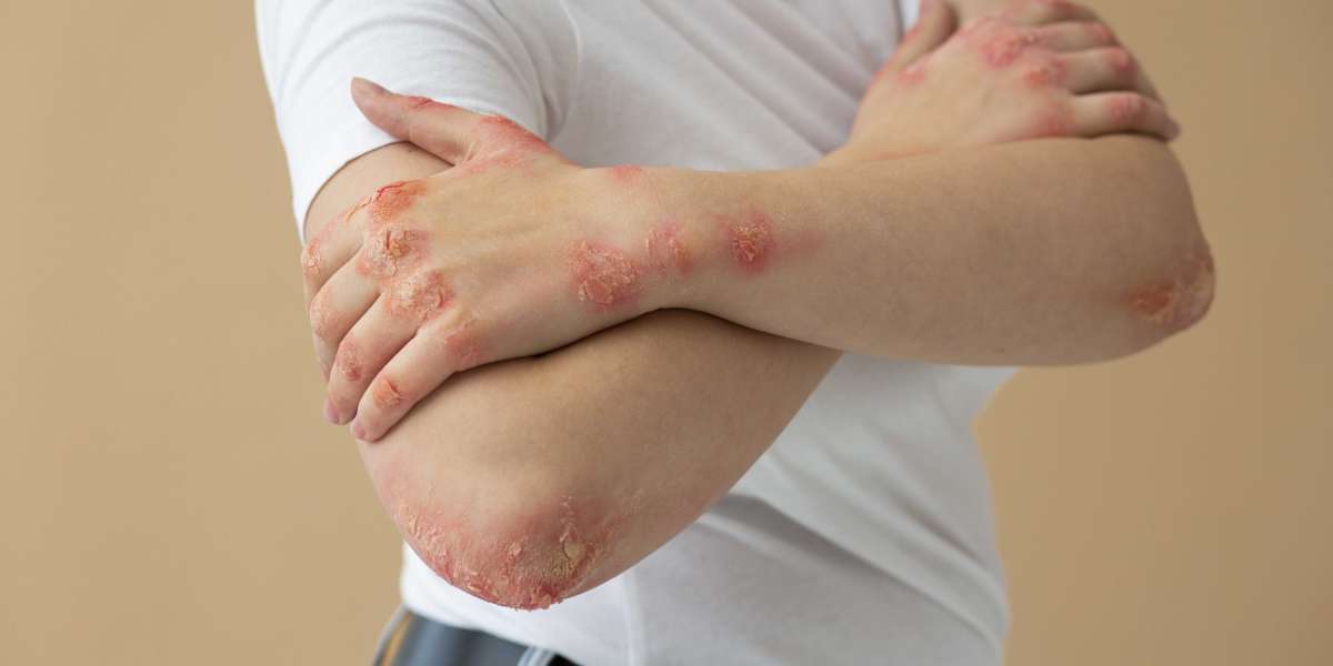 Ivercor 3mg – What Makes It a Popular Choice Against Parasites?